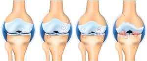 chữa bệnh thoái hóa khớp gối