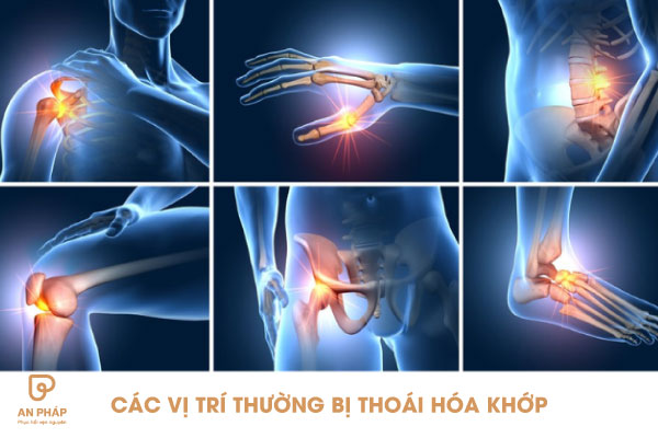 Các vị trí thường xuất hiện thoái hóa khớp