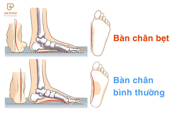 Bàn chân bẹt và bàn chân bình thường