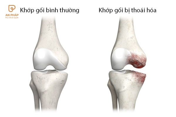 Thoái hóa khớp