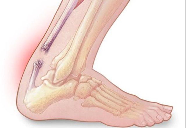 Viêm gân Achilles ở người chơi thể thao