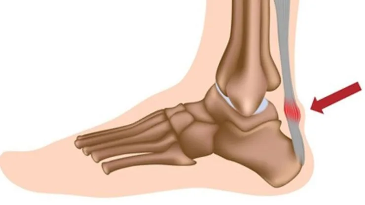 Tổn thương gân Achilles